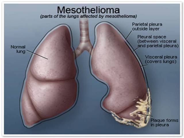 Mesothelioma Lung X ray Histology CXR CT Cancer Ribbon Cytology 